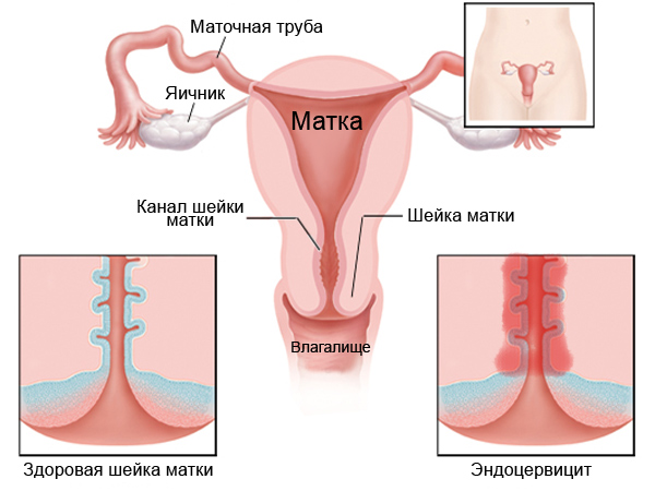 Предраковое состояние шейки матки. Что это такое, название, лечение 1-2-3 степени