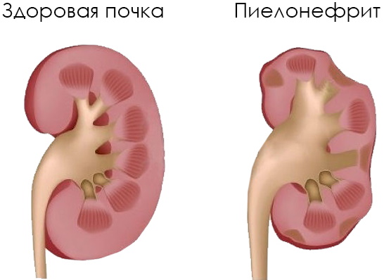 Боль при мочеиспускании у женщин в конце с кровью, жжение внизу живота. Причины, лечение