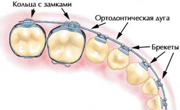 Брекеты на нижнюю, верхнюю, обе челюсти. Цены, установка, фото до и после