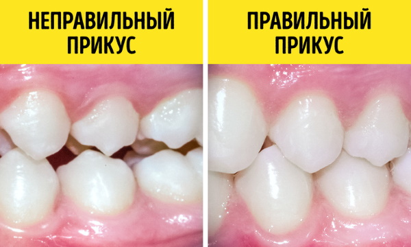 Брекеты на нижнюю, верхнюю, обе челюсти. Цены, установка, фото до и после