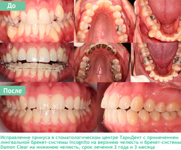 Брекеты на нижнюю, верхнюю, обе челюсти. Цены, установка, фото до и после