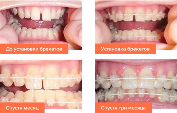 Брекеты на нижнюю, верхнюю, обе челюсти. Цены, установка, фото до и после
