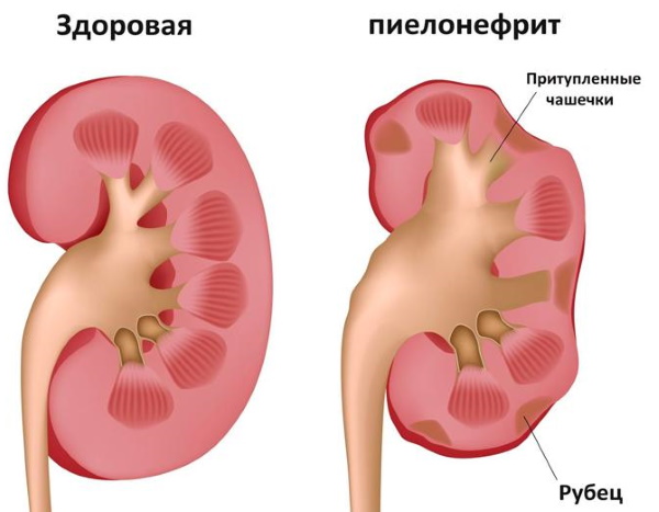 Enterococcus faecalis (энтерококк фекальный) в посеве на флору. Норма у женщин, мужчин. Лечение