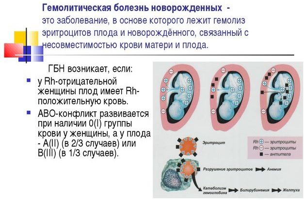 Гемолитическая болезнь новорожденного. Что это такое, лечение, клинические рекомендации