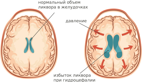 Головная боль и тошнота у женщин, при беременности. Причины, как избавиться