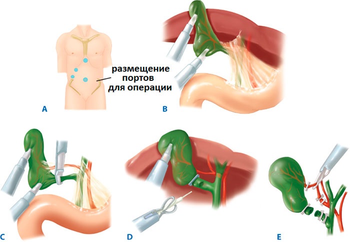 Холецистит у детей. Симптомы и лечение без температуры, кашля