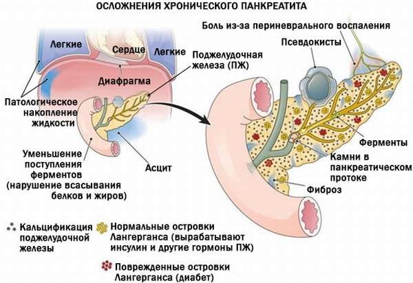 Симптомы панкреатита по авторам. Хирургия