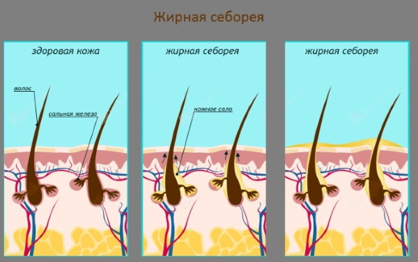 Мази от себорейного дерматита на лице, голове у взрослых. Цены, отзывы