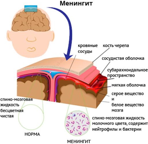 Менингококковая инфекция. Симптомы у взрослых, причины, лечение, осложнения