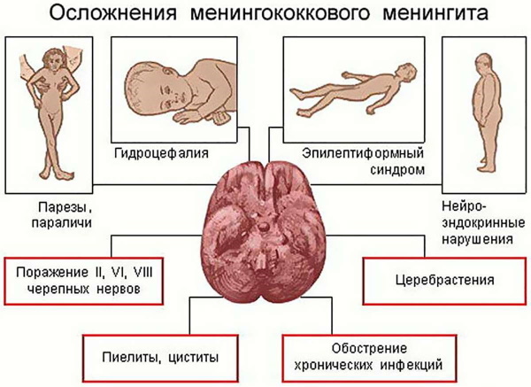 Менингококковая инфекция. Симптомы у взрослых, причины, лечение, осложнения