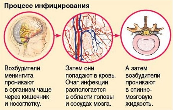 Менингококковая инфекция. Симптомы у взрослых, причины, лечение, осложнения