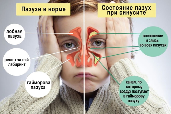 Капли Протаргол для детей. Инструкция по применению, отзывы, цена, аналоги