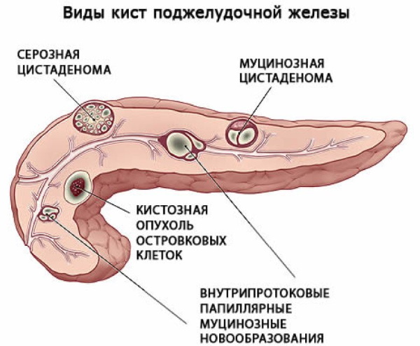 Панкреатит у женщин. Симптомы, лечение по возрасту, диета, препараты