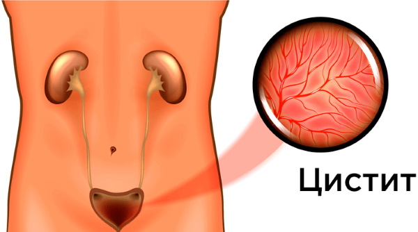 Цистит у женщин. Причины, симптомы и лечение