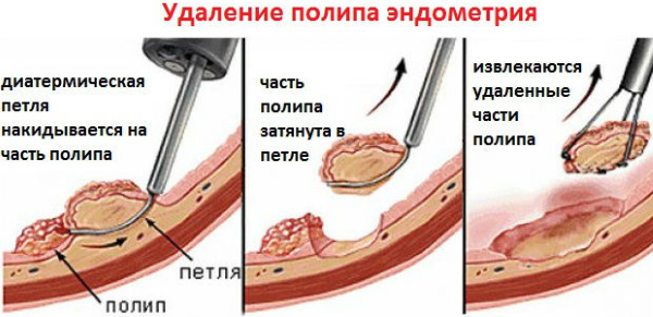 Удаление полипа матки лазером, гистероскопия эндометрия. Подготовка, восстановительный период