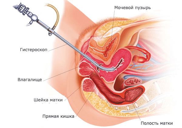 Удаление полипа матки лазером, гистероскопия эндометрия. Подготовка, восстановительный период