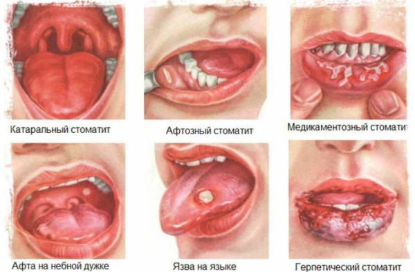 Зеленый язык. Причины у взрослого, ребенка. Что значит, что делать