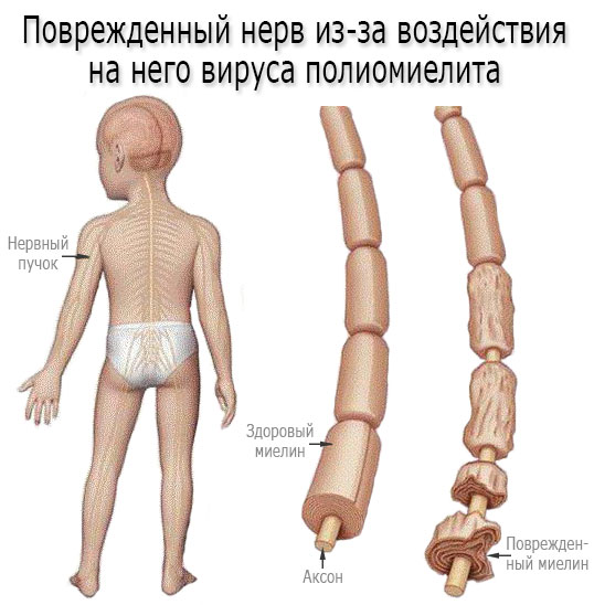 Живая аттенуированная вакцина. Что это такое, что значит, содержит .