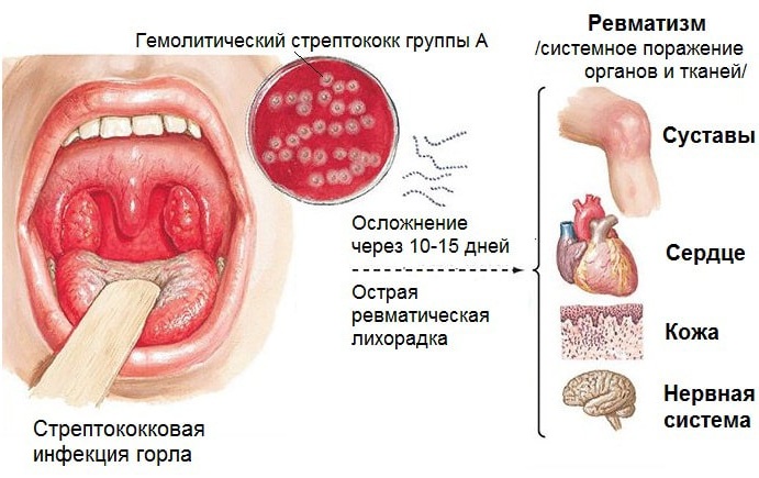 Антистрептолизин норма в крови у детей thumbnail