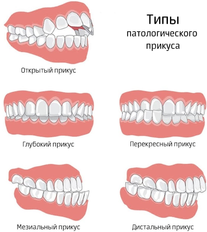 Сводит скулы и челюсть. Причины и лечение, что делать