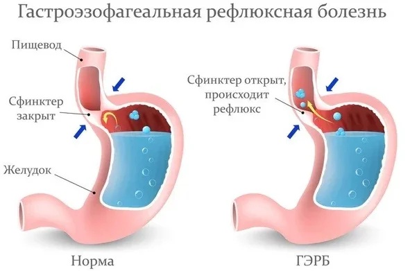 Диета при рефлюксе эзофагите. Меню на каждый день, неделю, в период обострения, рецепт