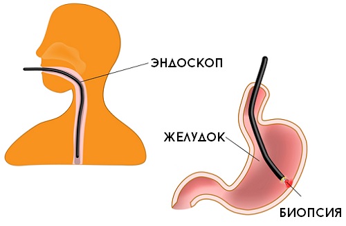 ЭГДС (эзофагогастродуоденоскопия). Подготовка к исследованию, меню, что можно и нельзя есть