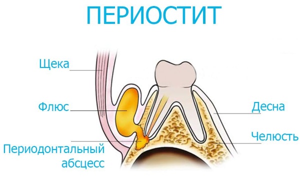 Флюс у ребенка 2-3-4 года. Фото, чем лечить