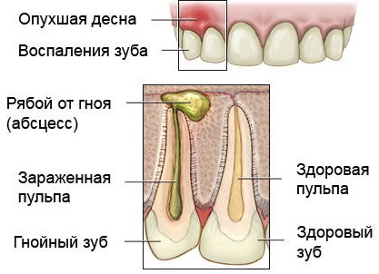 Лечение флюса в домашних условиях содой и уксусом thumbnail