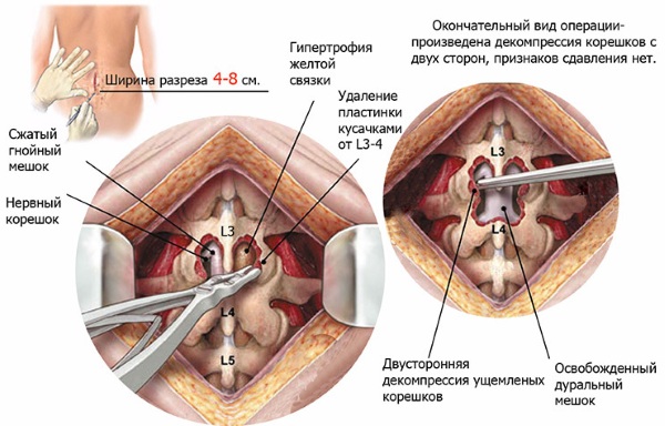 Грыжа позвоночника секвестрированная. Лечение, виды, симптомы, операция по удалению