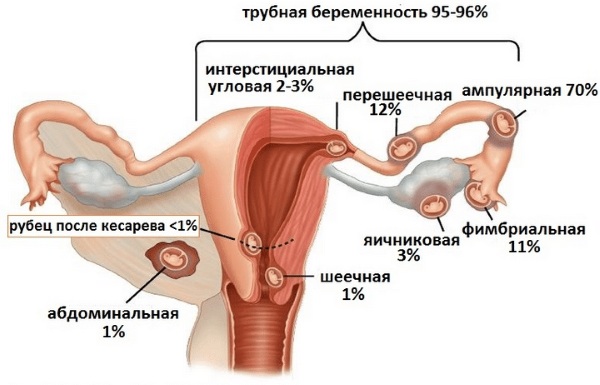 Климакс и беременность. Возможна ли после 50 лет, как распознать без месячных, признаки, тест