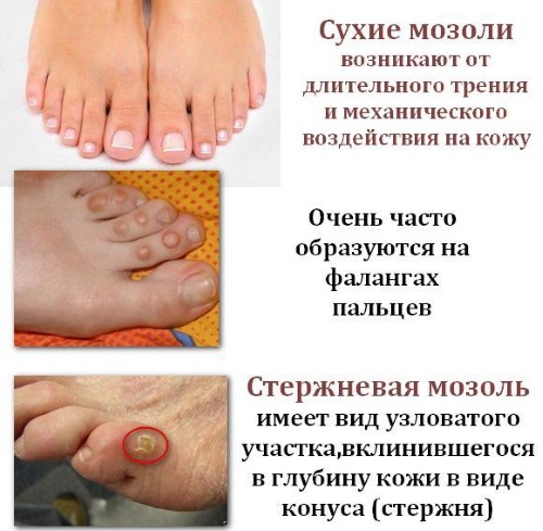 Компид (Compeed) пластырь от влажных мозолей, сухих, герпеса, натоптышей. Инструкция, виды, цена