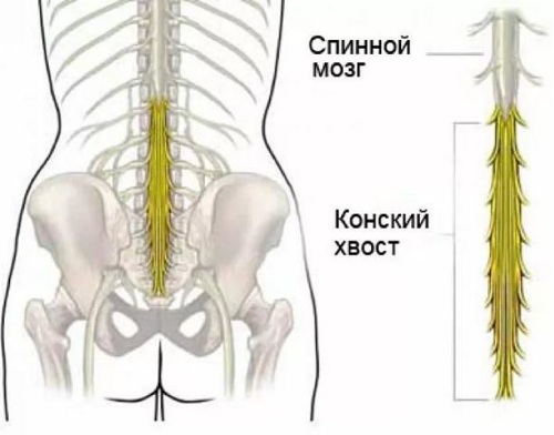 Конский хвост позвоночника. Анатомия, фото, симптомы и лечение у мужчин, женщин