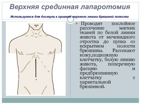 Перитонит. Симптомы, причины и лечение у взрослых женщин, мужчин