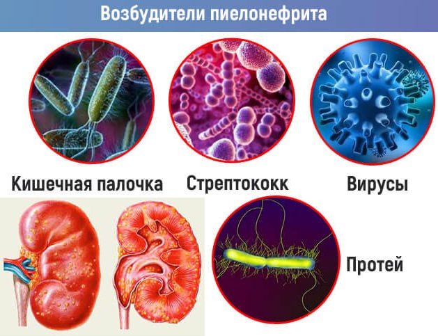 Пиелонефрит у женщин. Причины хронического, острого при беременности, лечение, последствия