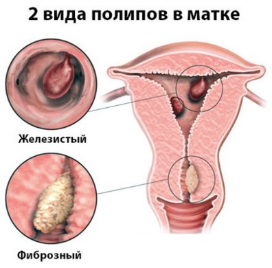 Полип в цервикальном канале. Можно ли забеременеть, лечение, кровоточит при беременности, операция, удаление, выскабливание