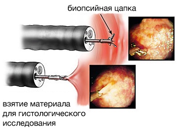 Полип в цервикальном канале. Можно ли забеременеть, лечение, кровоточит при беременности, операция, удаление, выскабливание