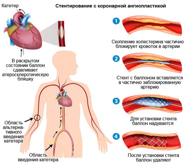 Препараты для чистки сосудов от холестерина и бляшек, травы, народные средства