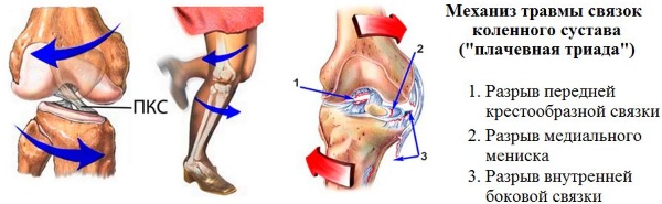 Разрыв связки коленного сустава. Симптомы, лечение, операция