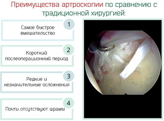 Разрыв связки коленного сустава. Симптомы, лечение, операция