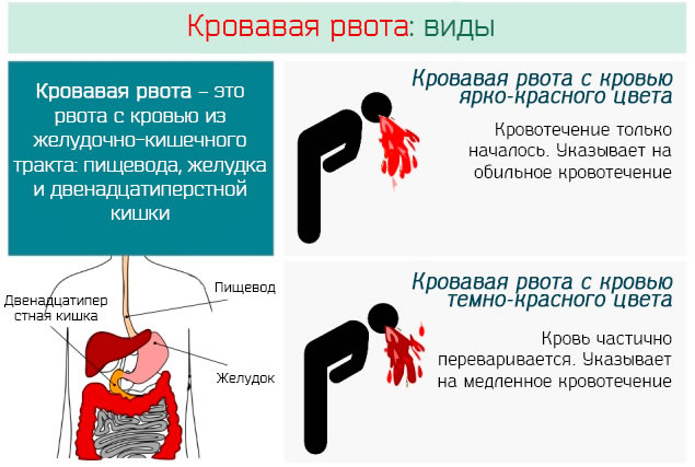 Синдром Золлингера-Эллисона. Что это такое, симптомы, лечение