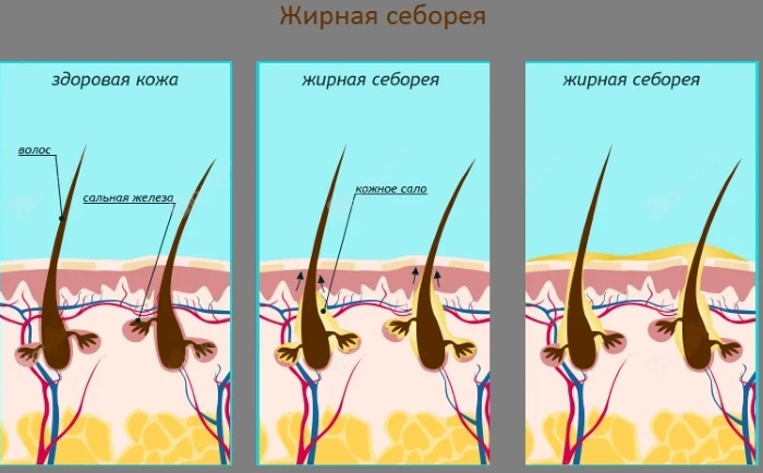 Себорея на лице. Фото жирная, сухая кожа, стадии, лечение