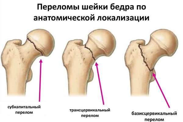 Перелом шейки бедра в пожилом возрасте. Симптомы вколоченного, субкапитального, закрытого, операция, реабилитация, лечение