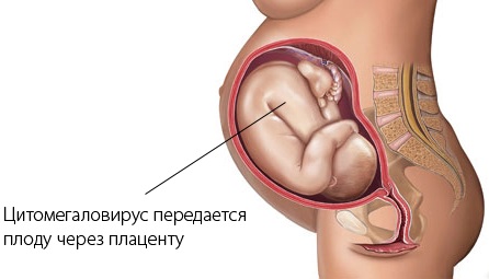 Цитомегаловирус IgG положительный. Что это значит в анализе у ребенка, женщины, лечение