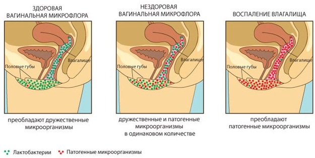 Уреаплазмоз у женщин. Симптомы и лечение, причины у беременных