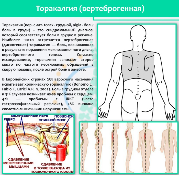 Вертеброгенная торакалгия. Что это такое, симптомы хронической, острой, ЛФК, лечение, последствия