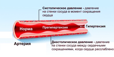 ВСД у женщин. Симптомы, как проявляется, признаки в стадии обострения, климакса, после родов. Лечение