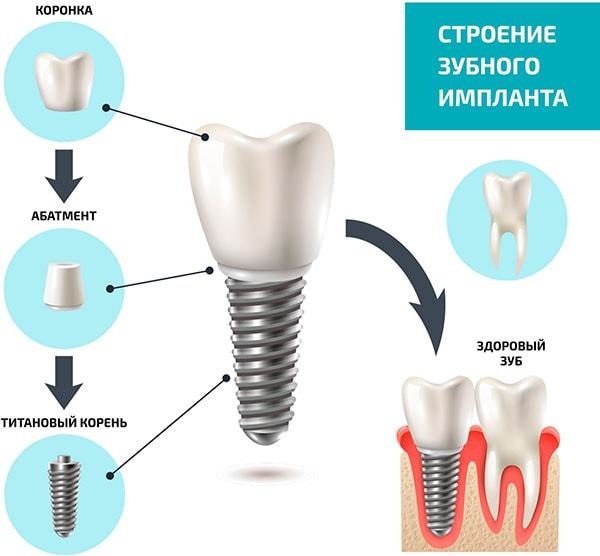 Как вставить имплант зуба. Виды, цена, больно ли, как это делается, отзывы