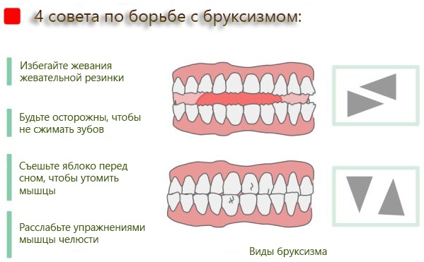 Сводит скулы и челюсть. Причины и лечение, что делать