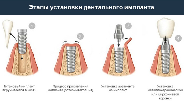 Как вставить имплант зуба. Виды, цена, больно ли, как это делается, отзывы