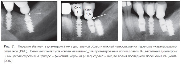 Абатменты для имплантов. Что это такое, где купить, виды, цена